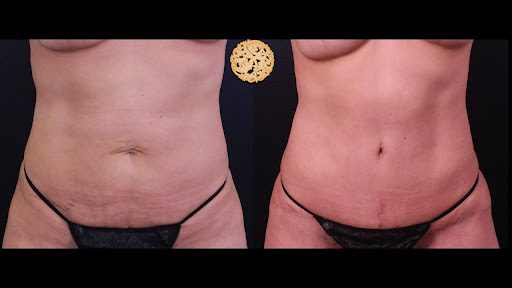 Halo Fractional Laser Resurfacing before and after