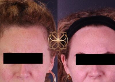 Before and after comparison of forehead Botox treatment showing reduction in fine lines and smoother skin