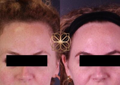 Before and after effects of Botox on forehead wrinkles, showing a smoother and more youthful skin texture