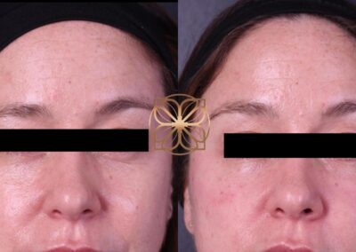 Front view before and after tear through filler treatment, illustrating the softening of eye lines and under-eye rejuvenation