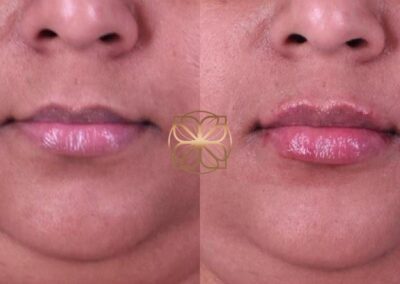 Close-up frontal view of lip enhancement from filler treatment, showing fuller lips with improved contour and symmetry
