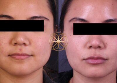 Frontal view before and after facial rejuvenation with Botox, fillers, and buccal fat pad removal, highlighting a smoother and more defined appearance
