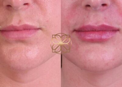 Frontal close-up showing the outcome of lip filler removal with Hylanex and subsequent refill, depicting the restored plumpness and definition