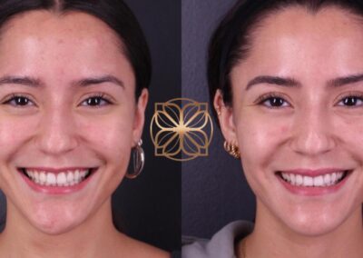 Front view of a smiling face showing the enhancement from Botox and fillers for a gummy smile, chin, nose, tear troughs, lips, and marionettes
