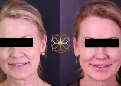 Frontal view before and after Liquid Facelift, demonstrating a significant reduction in facial lines and a refreshed, youthful appearance