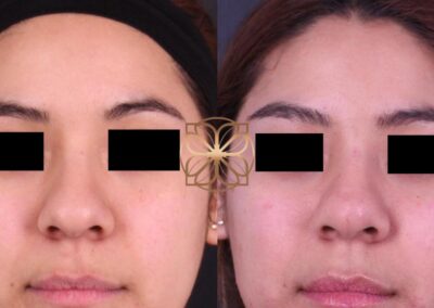 Frontal view comparison of nose filler treatment, also known as a liquid nose job, demonstrating improved nasal contour and structure