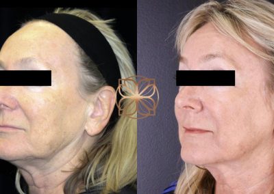 Halo After 4 Months Spa26 Beverly Hills