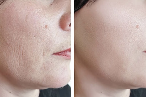 HALO Fractionated Resurfacing Benefits
