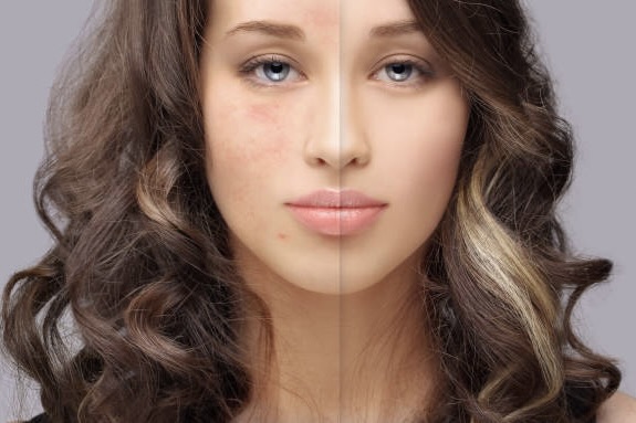 HALO Fractionated Resurfacing Treatment Areas