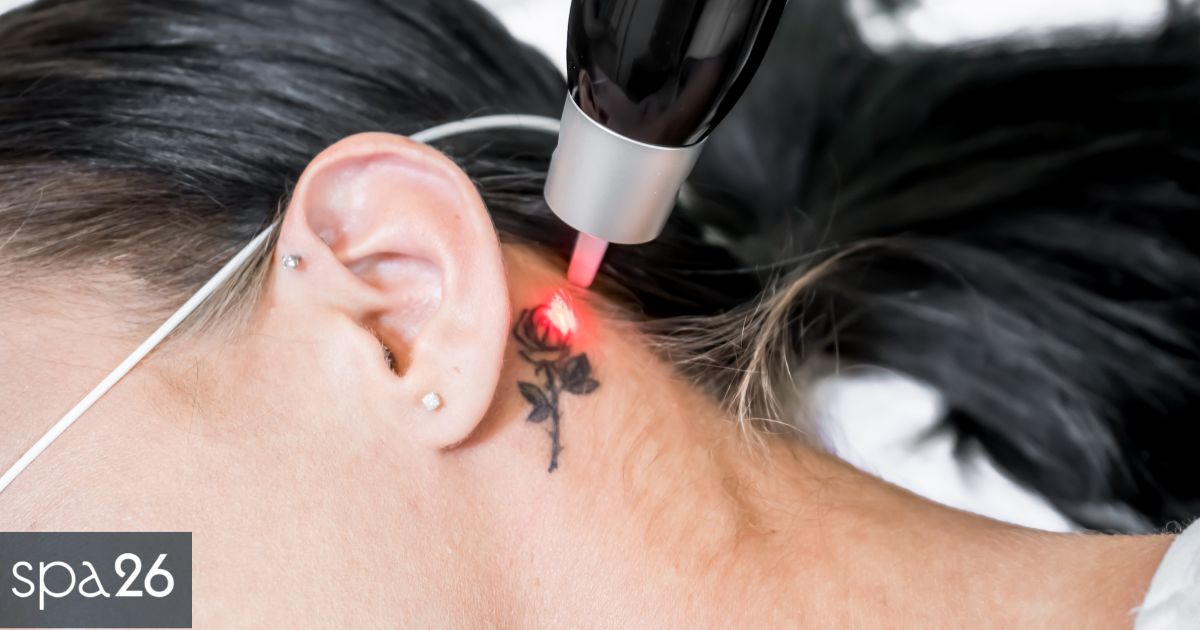 How-Laser-Tattoo-Removal-Works