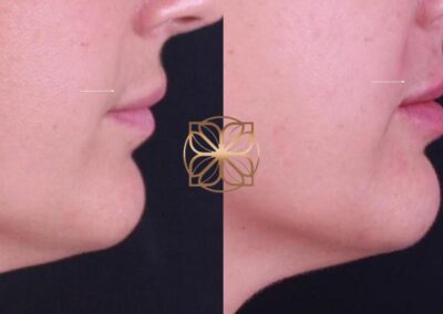Side profile comparison of lip treatment with Hylanex for filler dissolution followed by a refill, showing contour restoration