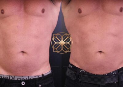 Before and after comparison of Kybella treatment for abdominal fat reduction, showing a more toned stomach area