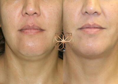 Before and after comparison of Kybella treatment for chin contouring and reduction of submental fullness