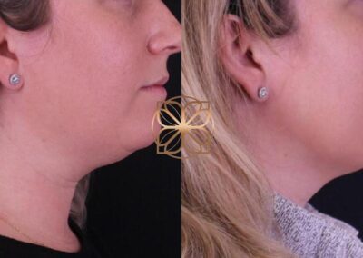 Profile view before and after Kybella fat reduction treatment, demonstrating a more contoured neck and jawline