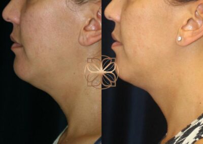 Profile view before and after Kybella treatment for neck and jawline, showing significant contouring and reduction of under-chin volume