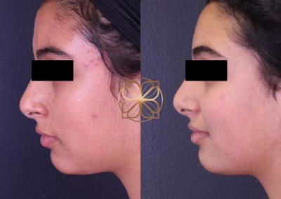Laser Hair Removal After 2 Sessions Spa26 Beverly Hills
