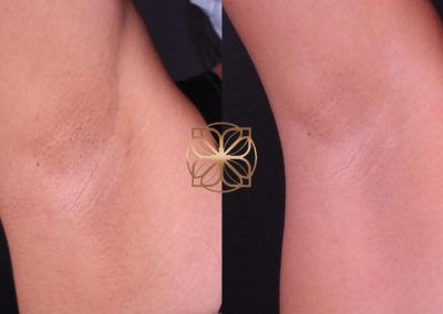 Laser Hair Removal After 2 Sessions Spa26 Beverly Hills