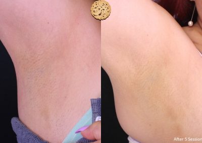 Laser Hair Removal After 5 Sessions Spa26 Beverly Hills