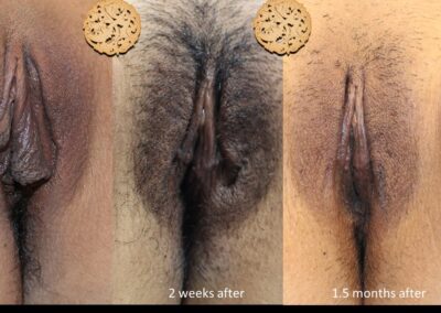 Before and After Comparison of Laser Vaginal Lightening Treatment at 2 Weeks and 1 Month Intervals Showing Visible Improvements