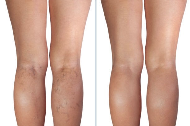 laser vein removal aftercare and recovery