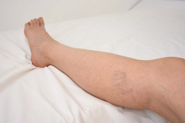laser vein removal treatment areas
