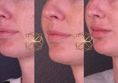 Sequential side profile views demonstrating the lip enhancement process, from filler dissolve to refill
