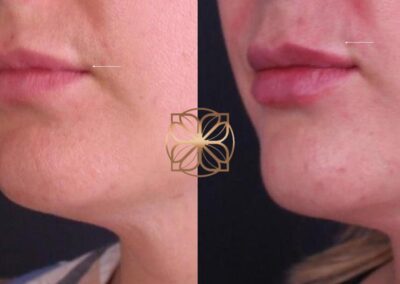Close-up view of lip filler correction with Hylanex treatment and subsequent filler refill, showing enhanced shape and volume