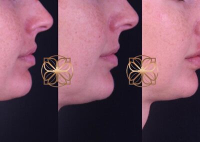 Progressive side profile views of lip filler dissolution and refill treatment, showing enhanced lip shape and volume