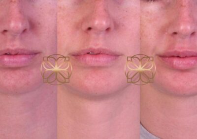 Front view of lip filler removal and refill transformation, showcasing gradual enhancement of lip fullness