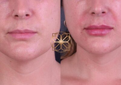 Close-up view of the results of a lip filler treatment, showing enhanced lip volume and definition