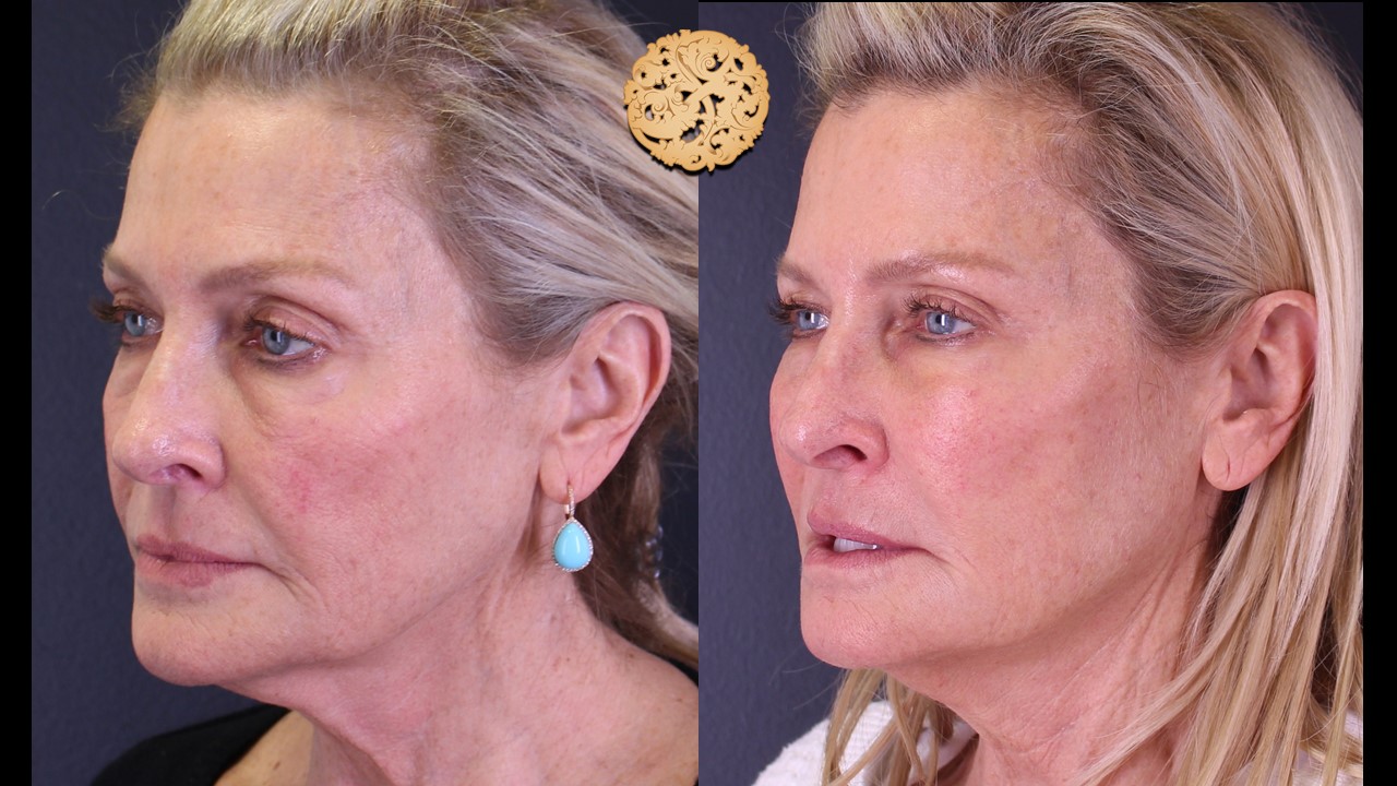 Liquid 1 non surgical liquid facelift