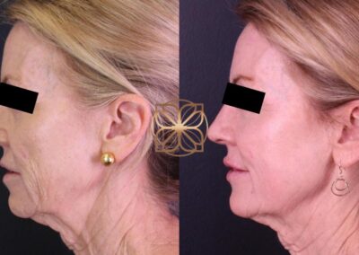 Profile view before and after a Liquid Facelift with fillers and Botox, showing rejuvenated facial features and skin tightening