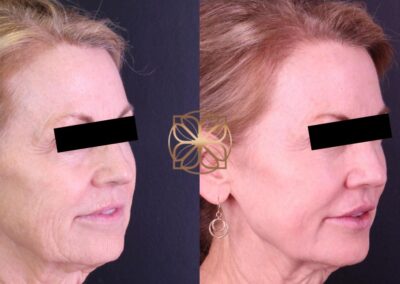 Side angle view of Liquid Facelift results, illustrating the reduction of wrinkles and enhanced facial volume post-treatment