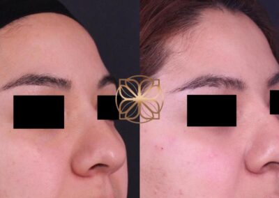 Close-up results of a liquid nose job using nose filler, showing refined nasal contours and profile