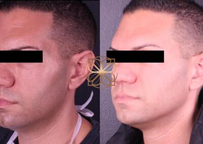 Close-up side view of male facial enhancement with filler, showcasing defined cheek and jawline after treatment
