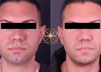 Frontal view before and after male facial filler treatment, highlighting facial symmetry and aesthetic enhancement