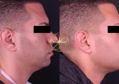 Profile view of male face filler treatment, showing enhanced jawline and chin contour post-procedure