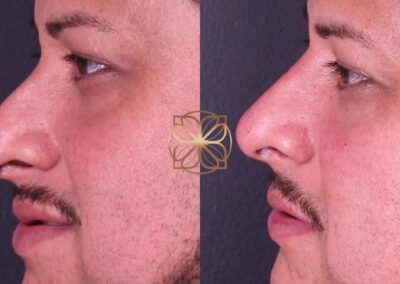 Close-up before and after comparison of male nose filler treatment, showing refined contour and shape
