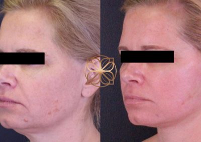 Microlaser Peel and Profractional Laser Resurfacing Spa26 Beverly Hills