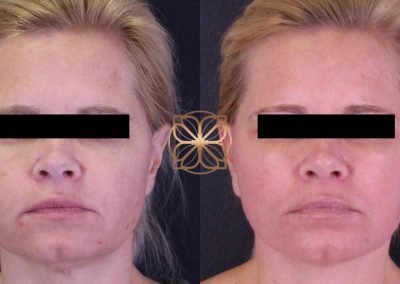 Microlaser Peel and Profractional Laser Resurfacing Spa26 Beverly Hills