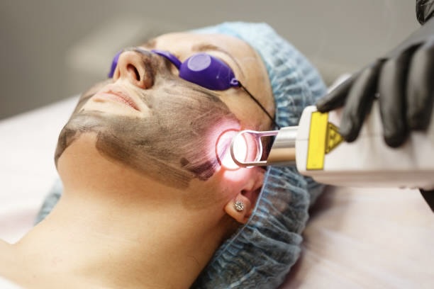 MicroLaser Peel Before & Preparation