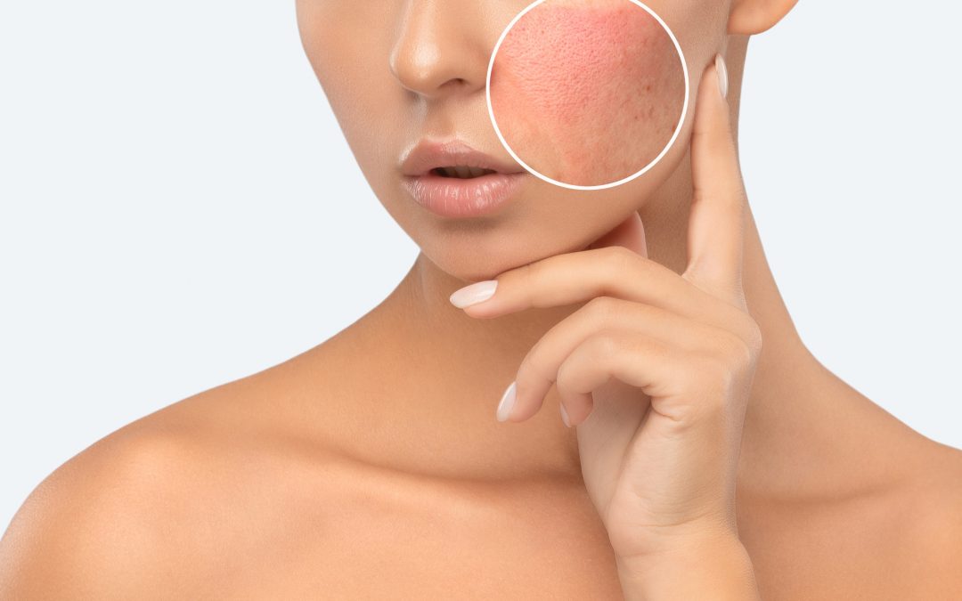 MicroLaser Peel for Resurfacing Beverly Hills
