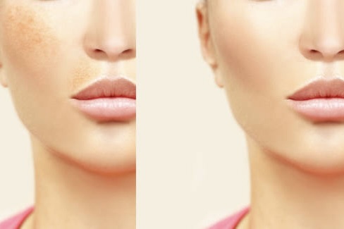 MicroLaser Peel Side Effects