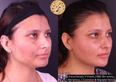 Before and after view of a woman's skin post-microneedling and acne treatment.