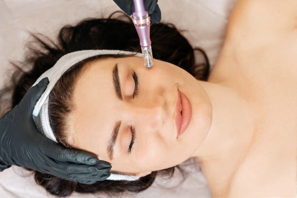 microneedling prp benefits