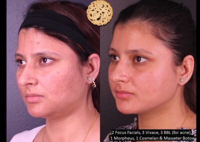 Before and after results of microneedling and acne treatments on female patient's skin.