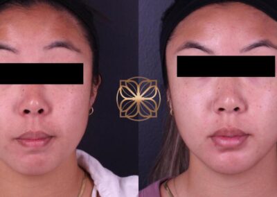 Before and after comparison showing facial enhancement with fillers to midface, tear troughs, lips, chin and Botox treatment