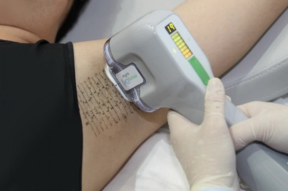 MiraDry Sweat Reduction Similar and Related Procedures