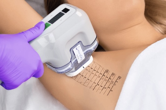 MiraDry Sweat Reduction Beverly Hills MiraDry Sweat Reduction Beverly Hills