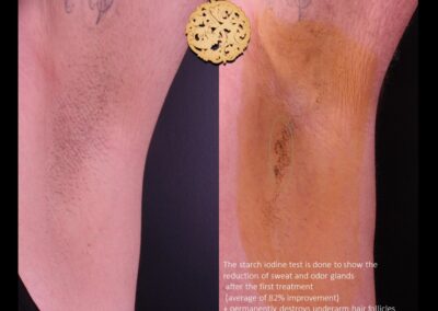 Before and after results of miraDry treatment showing significant sweat and odor gland reduction in underarm area.